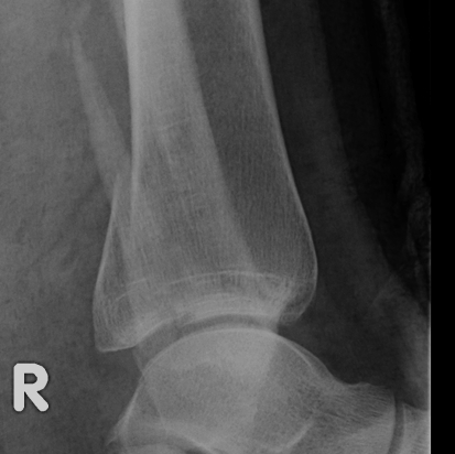 Ankle Fracture Large Posterior Malleolus Xray